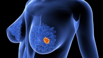 AI de Google detecta c&aacute;ncer de mama mejor que m&eacute;dicos