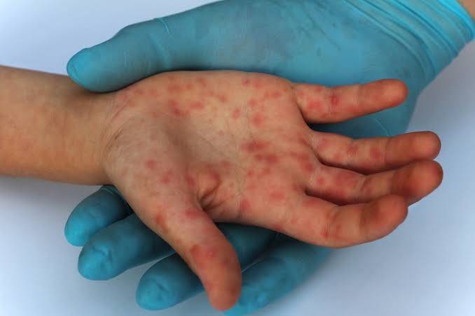 M&eacute;xico suma 81 casos confirmados de sarampi&oacute;n