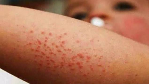 México reporta 122 casos de sarampión