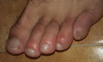 Inflamaci&oacute;n de extremidades y ronchas; presuntos s&iacute;ntomas de Covid-19 en ni&ntilde;os