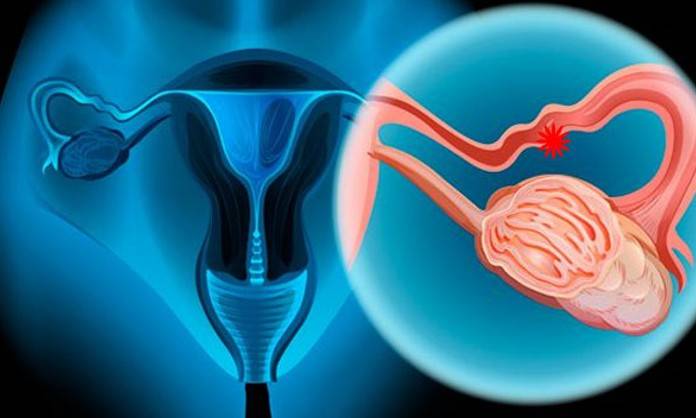 C&aacute;ncer de ovario ocupa el tercer lugar de mortalidad