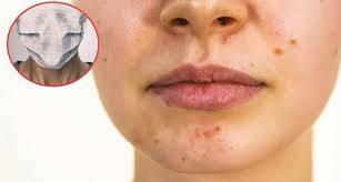 Maskne, el nuevo acn&eacute; por mascarilla