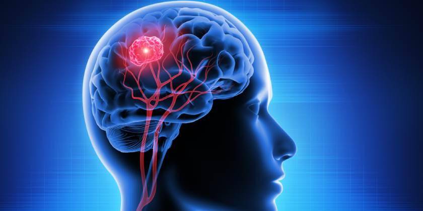 Al año, diagnostican 300 mil nuevos casos de tumores cerebrales en el mundo