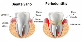 Caries y enfermedad periodontal, principales padecimientos por falta de higiene bucal