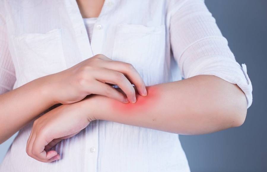 Cient&iacute;ficos estudian relaci&oacute;n de manifestaciones dermatol&oacute;gicas con el COVID-19