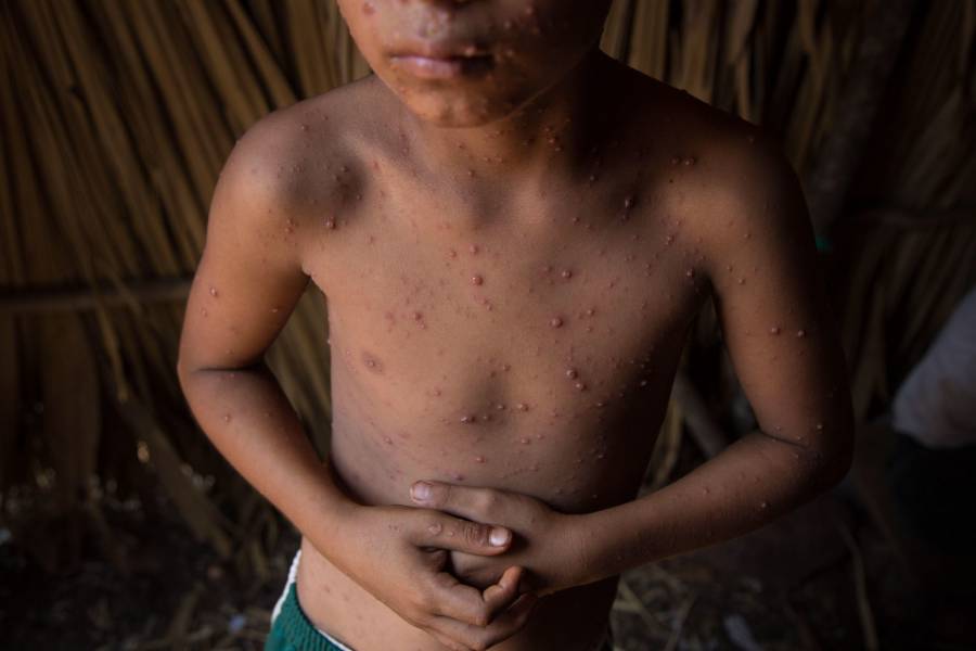 Medio millón de niños mueren al año en América por retraso en diagnóstico: OPS