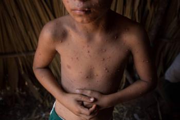 Medio mill&oacute;n de ni&ntilde;os mueren al a&ntilde;o en Am&eacute;rica por retraso en diagn&oacute;stico: OPS