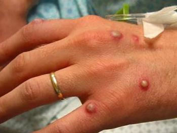 Estudian en Canad&aacute; 17 casos sospechosos de la viruela del mono
