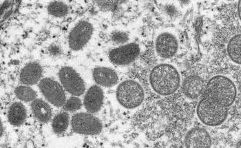 Riesgo de contagio de la viruela del mono es 