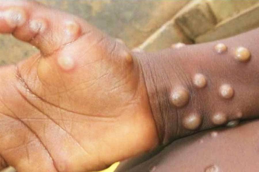 Van 131 casos de la viruela del mono a nivel mundial, reporta la OMS