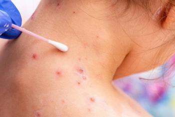 Van 21 casos de viruela del mono en EEUU; 700 casos a nivel global, seg&uacute;n los CDC