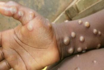 Viruela del mono cambiar&aacute; de nombre para evitar discriminaci&oacute;n, anuncia OMS