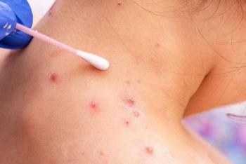 La OMS confirma m&aacute;s de 5 mil casos de viruela del mono en el mundo