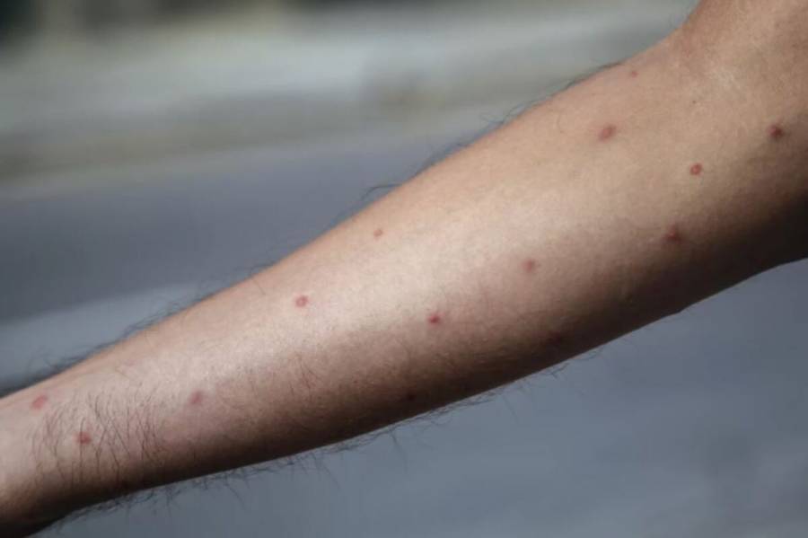 Estudian 2 casos sospechosos de viruela del mono en Querétaro