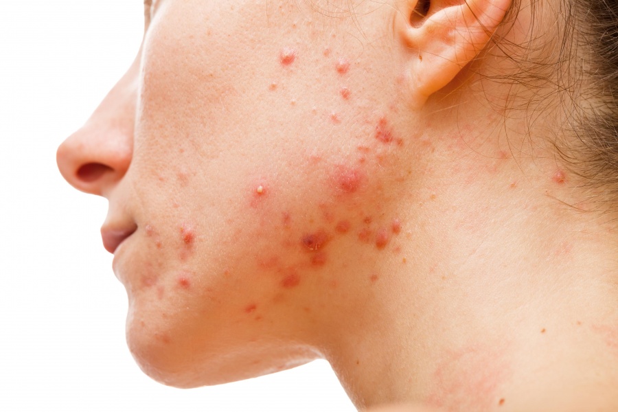 El acné afecta a más del 80 por ciento de los mexicanos: Fundación Mexicana de Dermatología