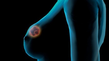 La innovaci&oacute;n en el c&aacute;ncer de mama metast&aacute;sico es indispensable para elevar la supervivencia de las pacientes: NOS