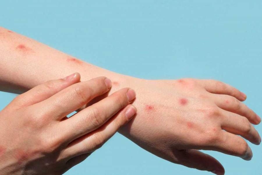 Salud confirma mil 627 casos de viruela del mono en el país
