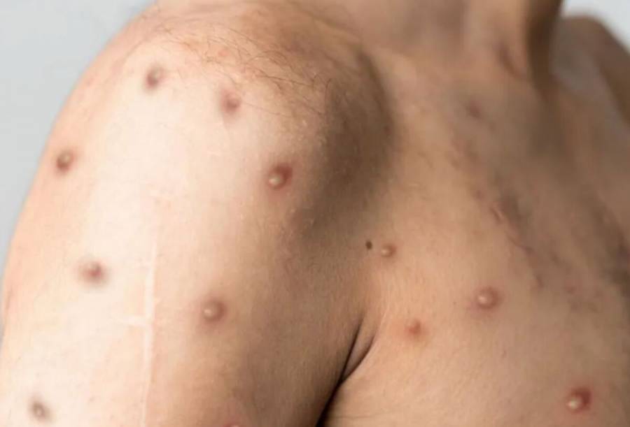 M&eacute;xico supera los 2 mil 600 casos confirmados de viruela del mono
