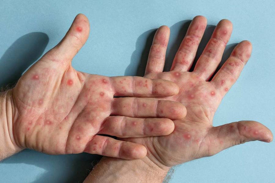 Más de 4 mil contagios y 26 defunciones por viruela símica en México