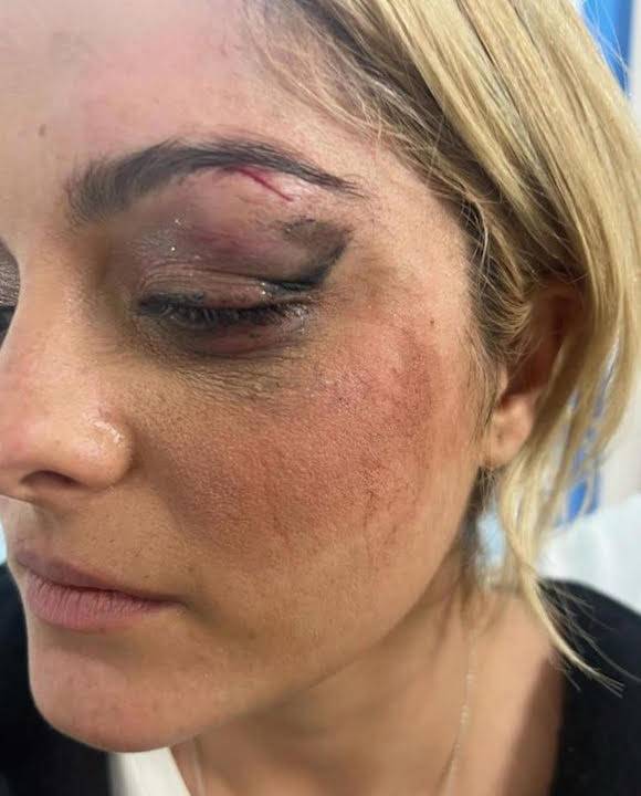 Cantante Bebe Rexha recibe golpe de un celular en pleno concierto y detienen al agresor