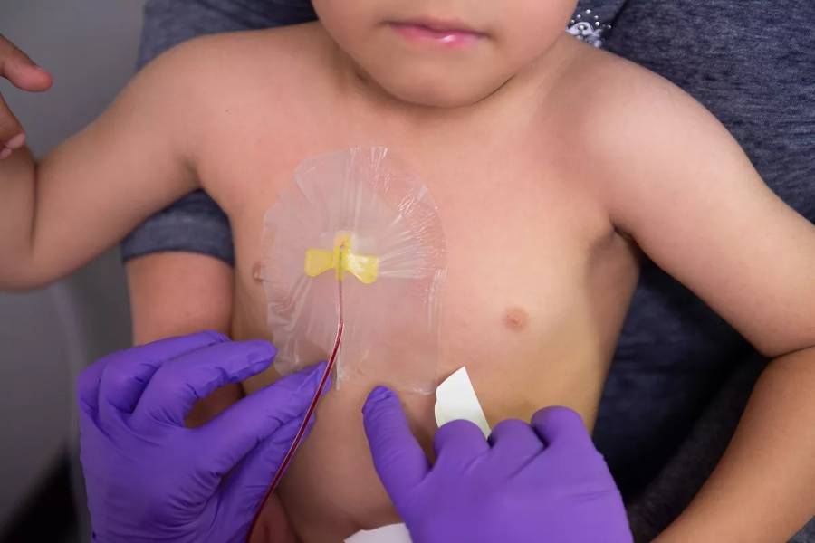 Busca IMSS implementar en pacientes pediátricos oncológicos dispositivo no invasivo para suministro de medicamentos