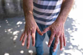 Secretar&iacute;a de Salud federal emite aviso epidemiol&oacute;gico por mpox