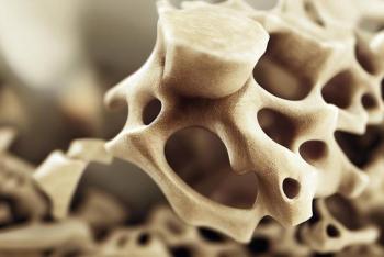 INR alerta: osteoporosis afecta 10 millones de personas en M&eacute;xico