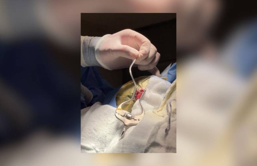 Gobierno del Estado realiza cirugías gratuitas para tratar cardiopatías congénitas en menores