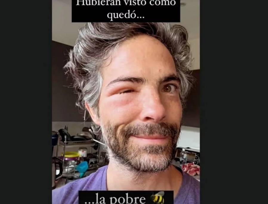 ¡Irreconocible! Osvaldo Benavides aparece con el rostro desfigurado: ¿qué le pasó?