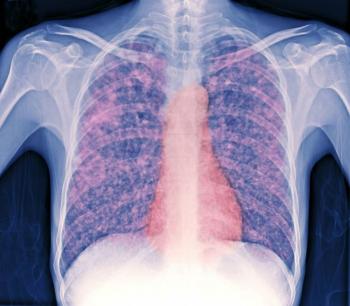 Veracruz lidera casos de tuberculosis respiratoria en México en 2025