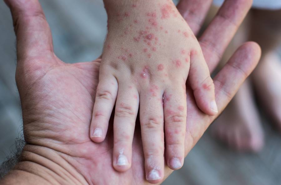 México supera los 4 mil contagios de sarampión; Chihuahua concentra la mayoría