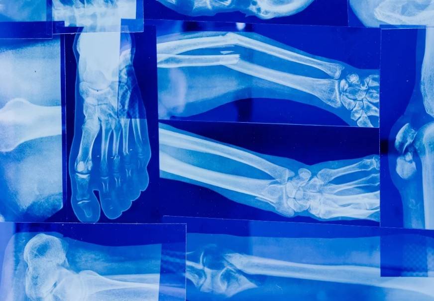 Micropl&aacute;sticos podr&iacute;an debilitar los huesos y aumentar el riesgo global de fracturas