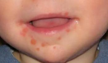 Confirman Brote de Virus Coxsackie en Campeche: ¿Qu&eacute; Es y Cu&aacute;les Son Sus S&iacute;ntomas?