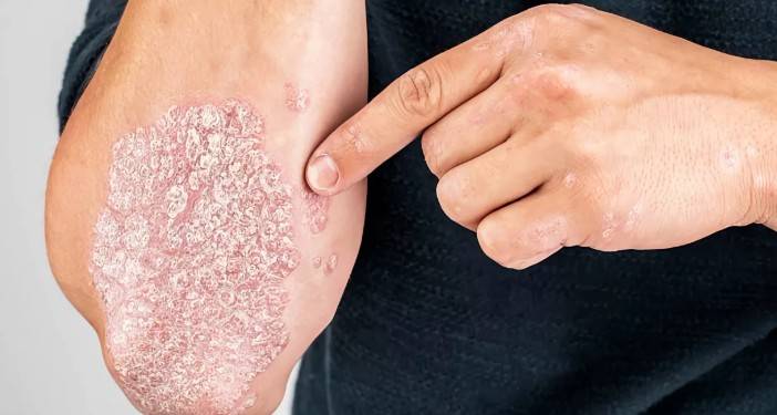 Psoriasis: una enfermedad cr&oacute;nica que va m&aacute;s all&aacute; de la piel