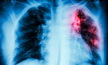 Casos de tuberculosis alcanzan r&eacute;cord mundial en 2024 mientras las muertes globales bajan: informe de la OMS