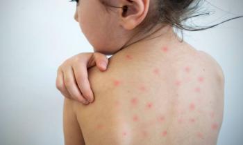 Alerta sanitaria en Chiapas por aumento de casos de sarampi&oacute;n en 2025