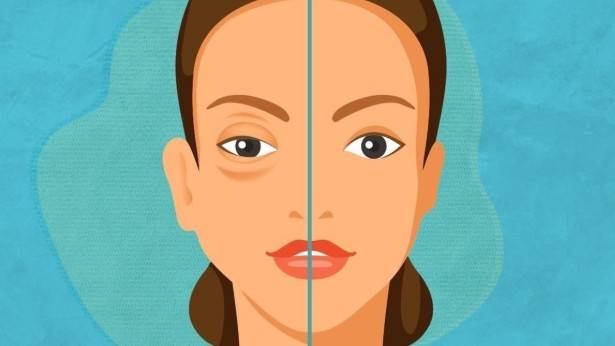 Quer&eacute;taro se suma al D&iacute;a Mundial del Angioedema Hereditario; llama a detecci&oacute;n oportuna