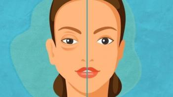 Quer&eacute;taro se suma al D&iacute;a Mundial del Angioedema Hereditario; llama a detecci&oacute;n oportuna