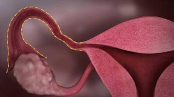 Muertes por c&aacute;ncer de cuello uterino llegan a cero en j&oacute;venes inglesas gracias a la vacuna contra VPH