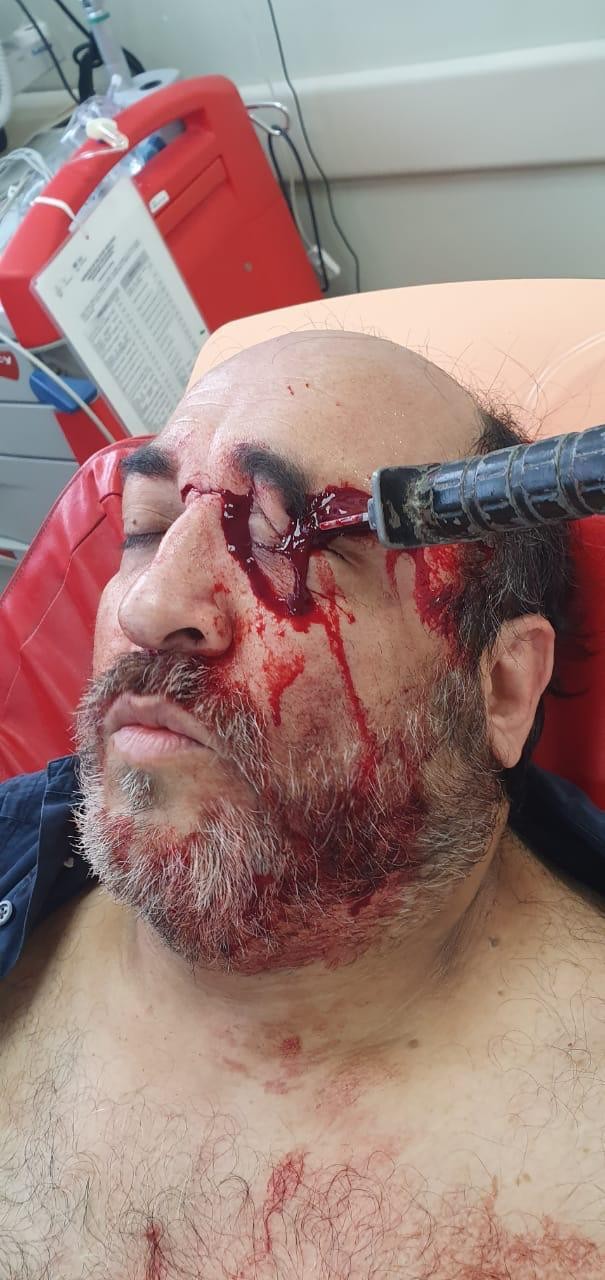 Hombre pierde el ojo tras una riña por un lugar de estacionamiento